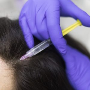 زراعة الشعر بتقنية الاقتطاف