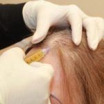 زراعة الشعر بتقنية الاقتطاف