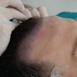 زراعة الشعر للرجال في تركيا