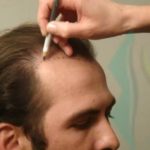 زراعة الشعر بتقنية الاقتطاف fue