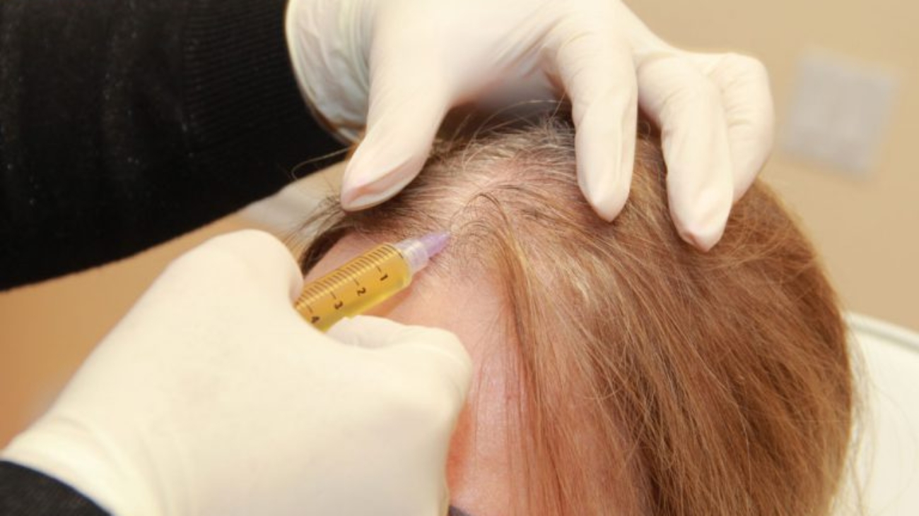 زراعة الشعر بتقنية الاقتطاف