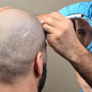 زراعة الشعر للرجال في تركيا