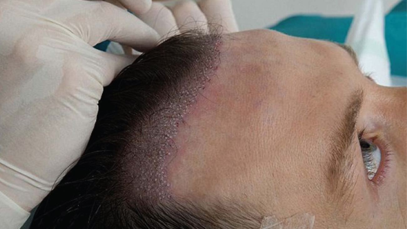 زراعة الشعر للرجال في تركيا