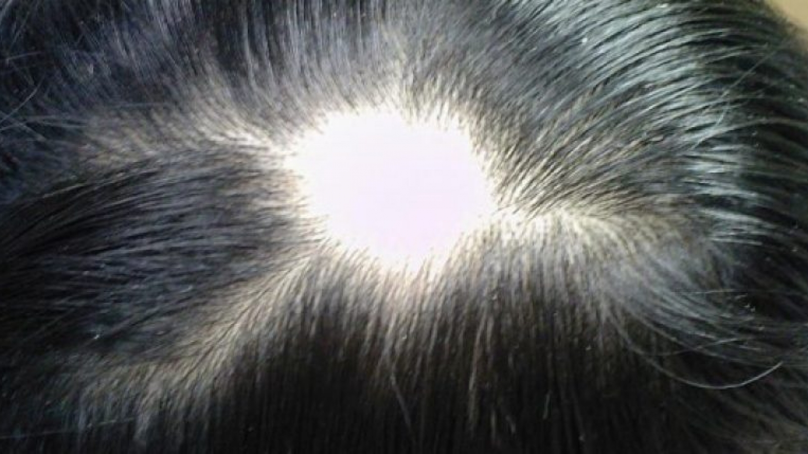 Выпадают волосы 4 месяц. Гнёздная (очаговая алопеция). Очаговая алопеция (alopecia Areata). Гнездная алопеция офиазис.