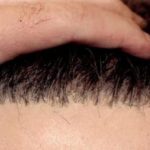 نصائح لزراعة الشعر في تركيا
