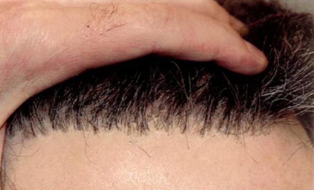 نصائح قبل عملية زراعة الشعر - مركز جواد | Jawad Medical