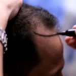 مميزات زراعة الشعر بتقنية الاقتطاف