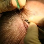 زراعة الشعر باستخدام شعر الجسم BHT