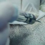 الأدوات المستخدمة في زراعة الشعر بتقنية الاقتطاف FUE
