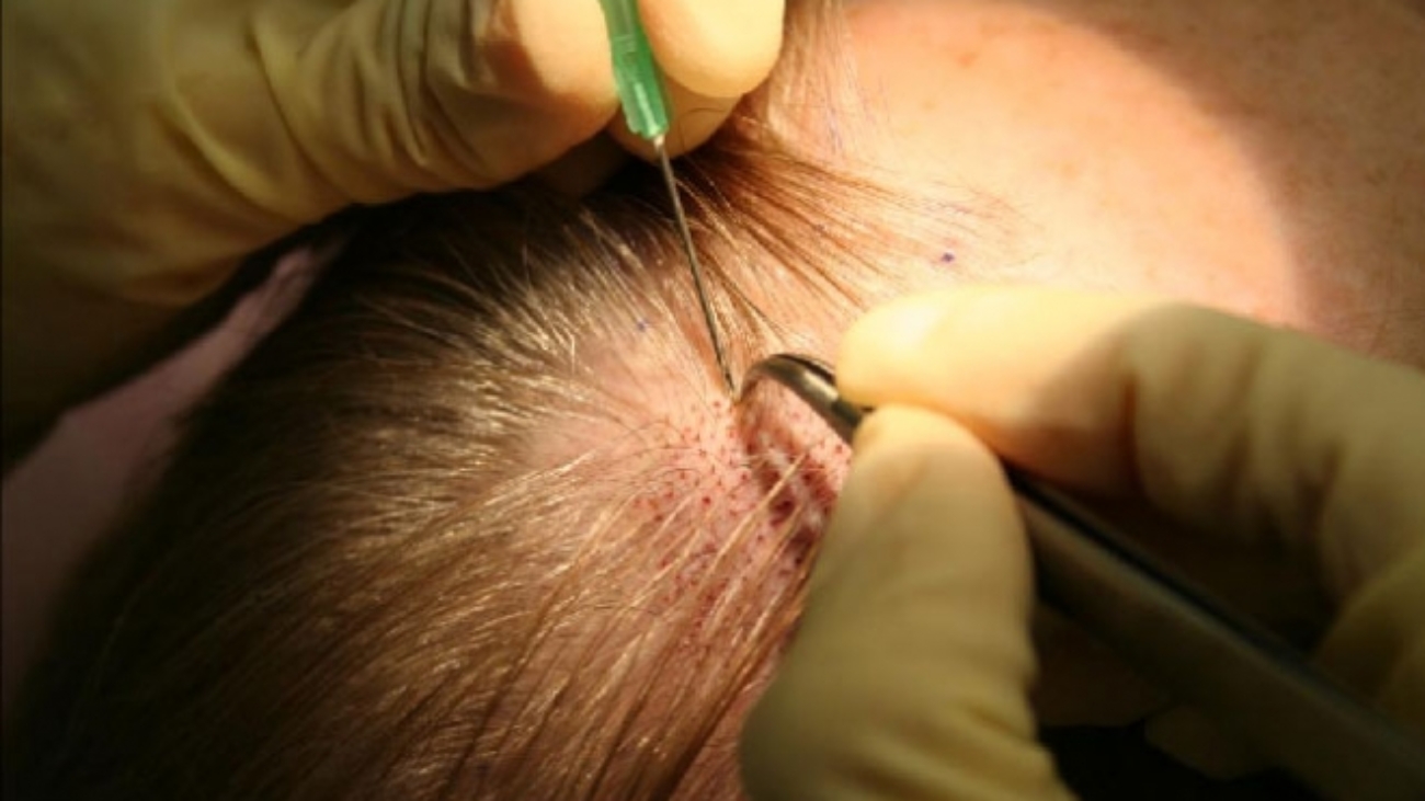 زراعة الشعر باستخدام شعر الجسم BHT