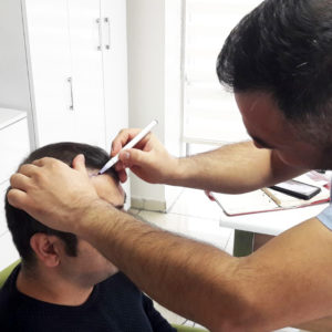 زراعة الشعر بدون حلاقة