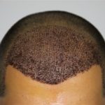 الالتهاب بعد زراعة الشعر