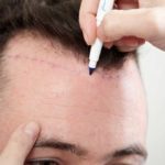 تعرف الى تاريخ زراعة الشعر في تركيا
