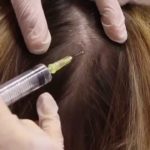 صورة حقن الميزوثيرابي للشعر Mesotherapy