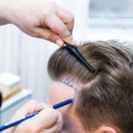 أقلام تشوي لزراعة الشعر في تركيا