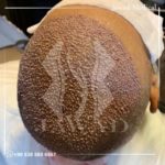 زراعة الشعر في طرابزون