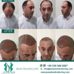 افضل مركز زراعة شعر في طرابزون
