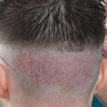 إجراء عملية زراعة الشعر في تركيا