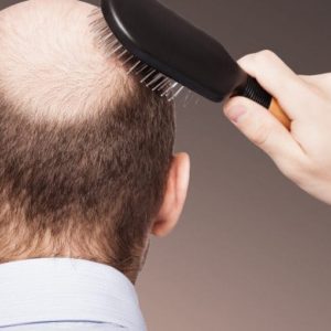 إجراء عملية زراعة الشعر في تركيا