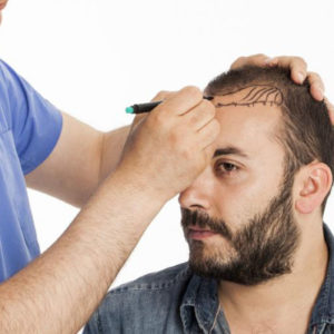 زراعة الشعر في تركيا مع جواد الطبي