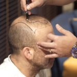 أحدث تقنيات زراعة الشعر في تركيا