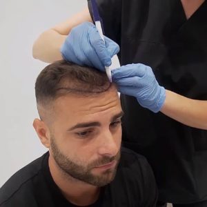 أحدث تقنيات زراعة الشعر في تركيا