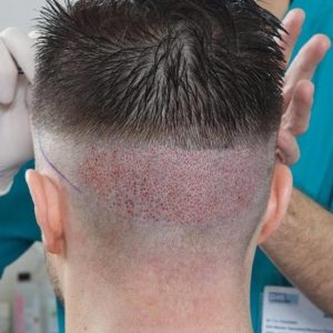 زراعة الشعر بتقنية البيركوتان Perkutan