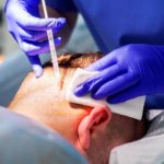 زراعة الشعر بتقنية السفير (Sapphire FUE) في تركيا