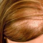 زراعة الشعر في تركيا للنساء