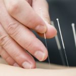 علاج الوخز بالإبر في تركيا