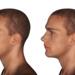 تجميل الأنف عند الرجال