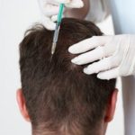 زراعة الشعر بالخلايا الجذعية