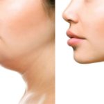 أفضل دكتور تجميل للذقن