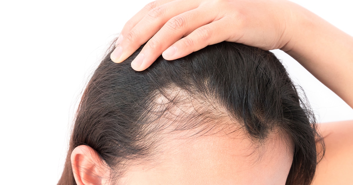 علاج تساقط الشعر بالميزوثيرابي