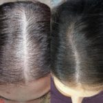 تجارب زراعة الشعر