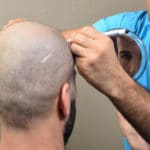 أفضل مراكز زراعة الشعر في تركيا