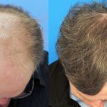 اسعار زراعة الشعر في تركيا