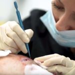 تجارب زراعة الشعر في تركيا