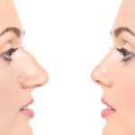 تكلفة عملية تجميل الانف