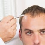 عروض زراعة الشعر في تركيا