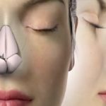 عملية تجميل الانف بالفيلر