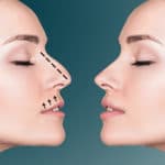 مضاعفات عملية تجميل الأنف