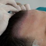 هل زراعة الشعر ناجحه