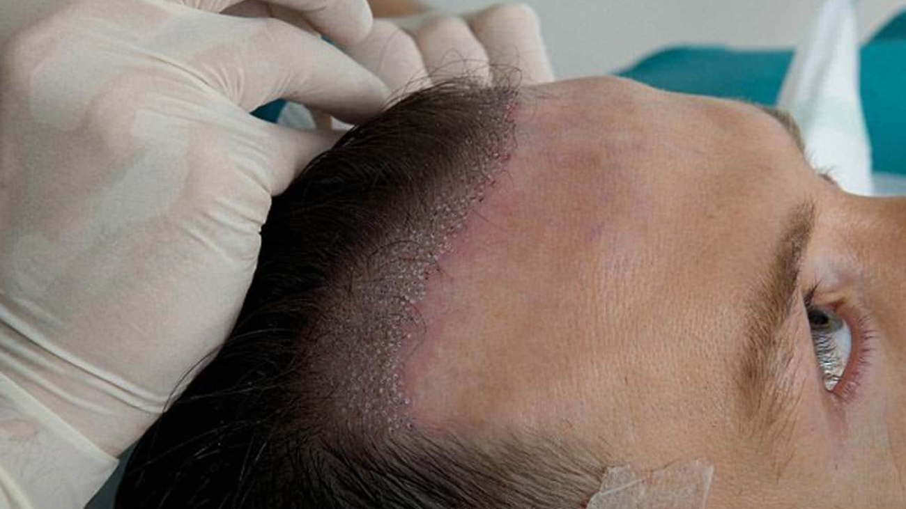 هل زراعة الشعر ناجحه