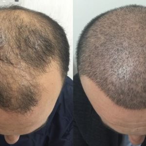 تكلفة زراعة الشعر في تركيا