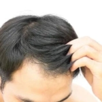 تكلفة زراعة الشعر في تركيا
