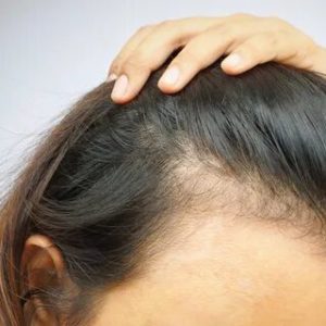 تكلفة زراعة الشعر في تركيا