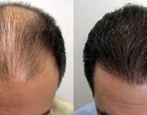 تكلفة زراعة الشعر في تركيا