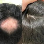 مدة زراعة الشعر في تركيا