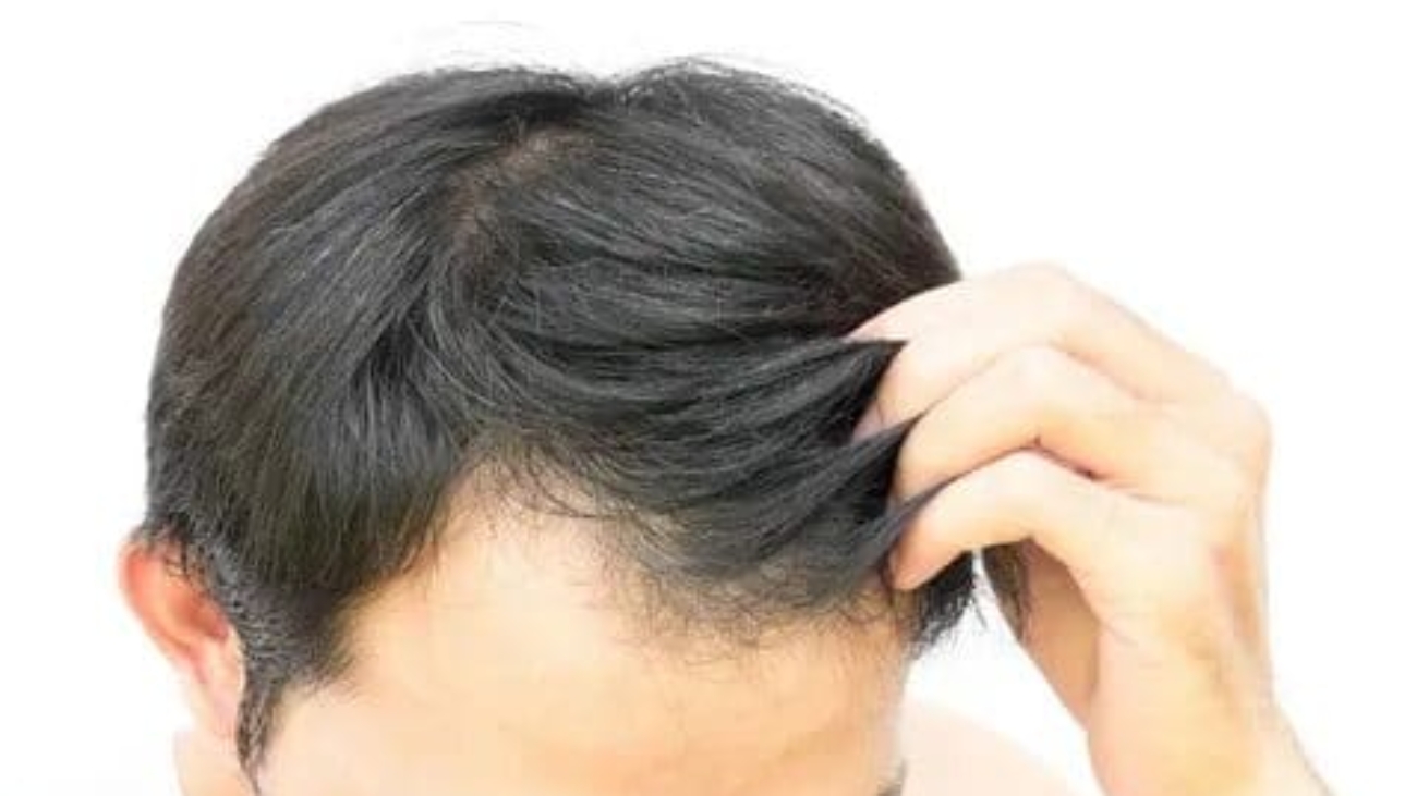 تكلفة زراعة الشعر في تركيا